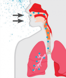 La enfermedad del legionario es un tipo grave de neumonía causado por la inhalación de aerosoles que contienen la bacteria Legionella