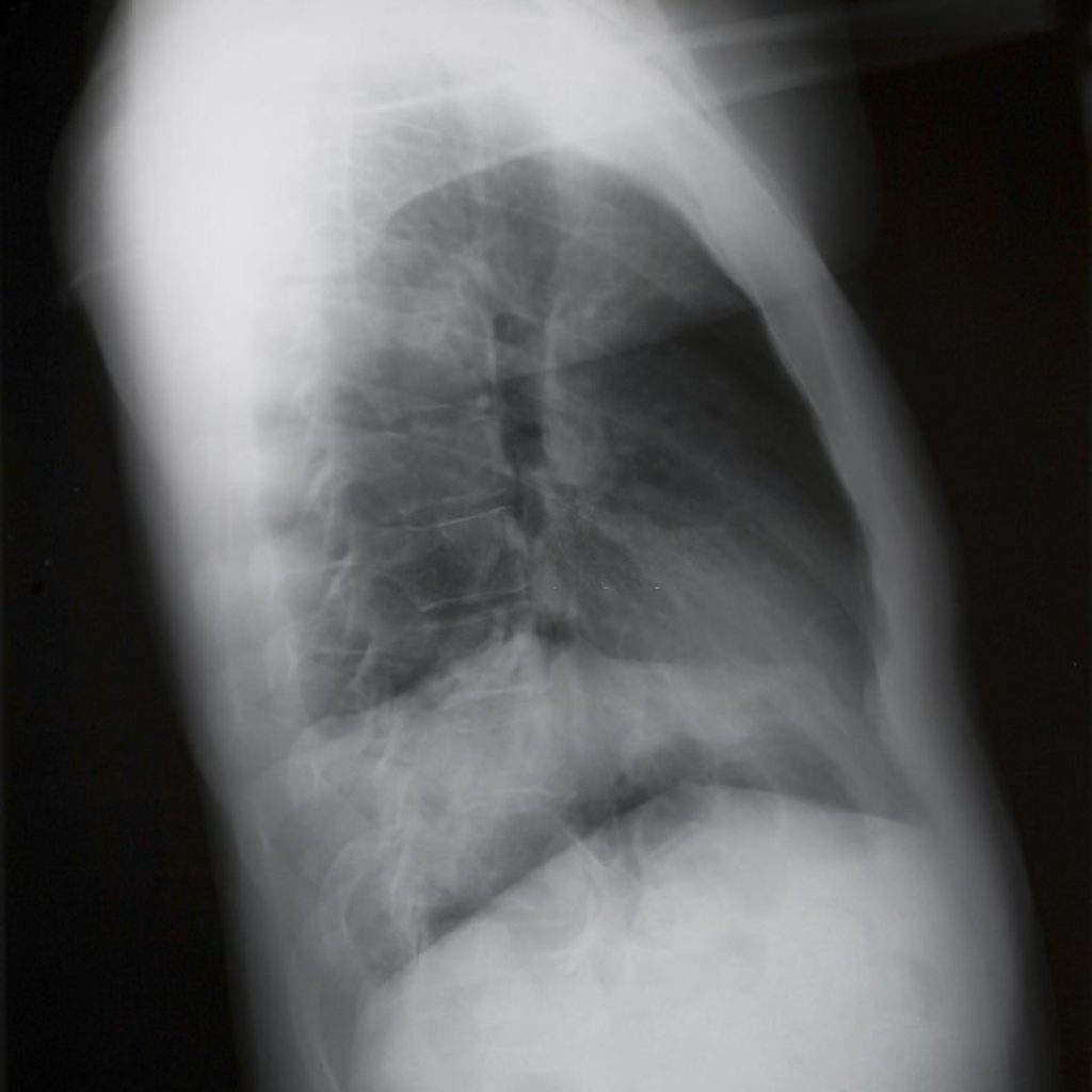 Rayos X a pulmón con silicosis