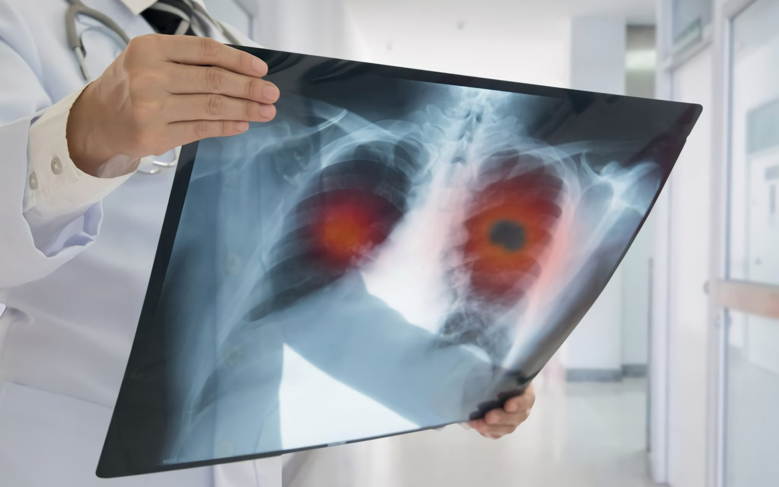 Radiografía en pulmones dañados por la sílice cristalina