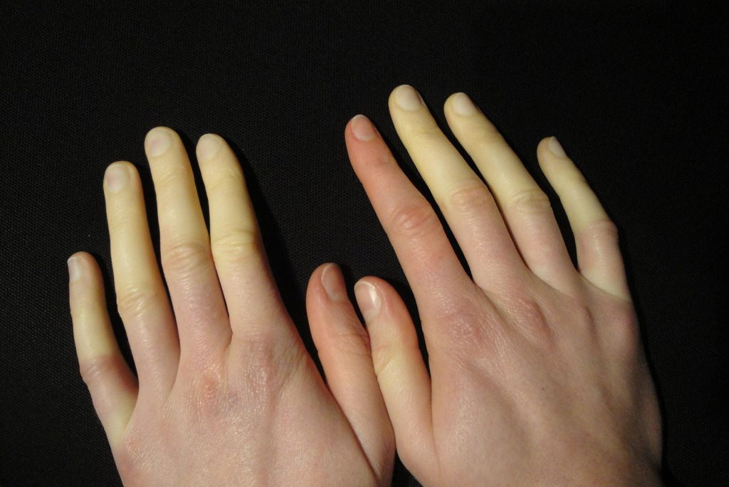 Efectos de la exposición a vibraciones mano-brazo